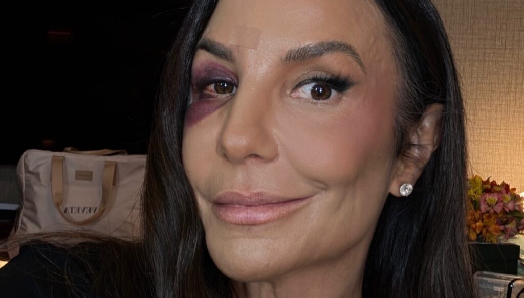 Ivete Sangalo da detalhes de acidente domestico