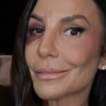 Ivete Sangalo da detalhes de acidente domestico